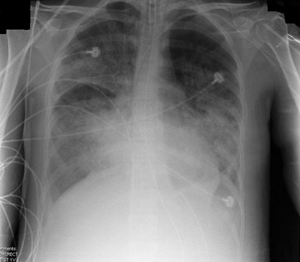 Acute Respiratory Distress Syndrome | USMLE Strike