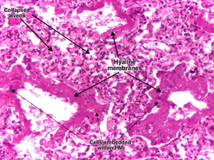 Acute Respiratory Distress Syndrome | USMLE Strike