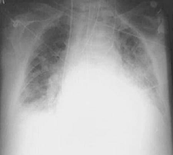 Pulmonary Edema | USMLE Strike